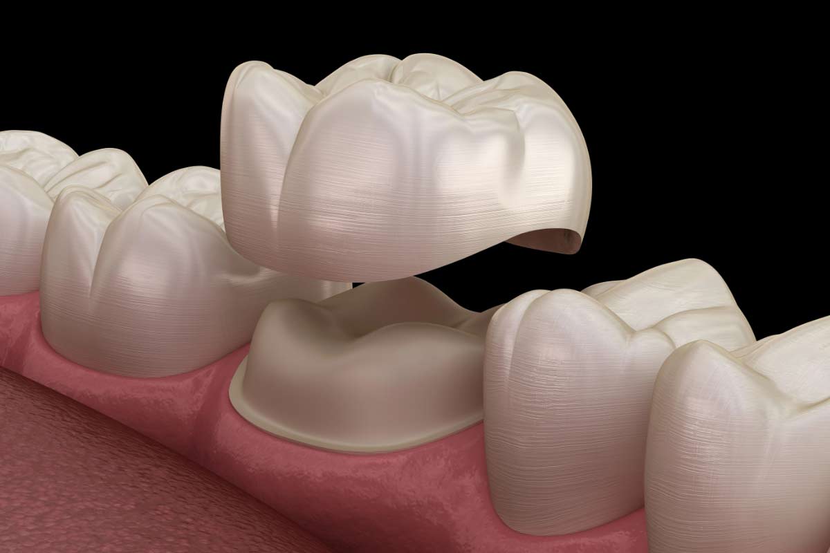 3D model showing how a dental crown repairs a tooth